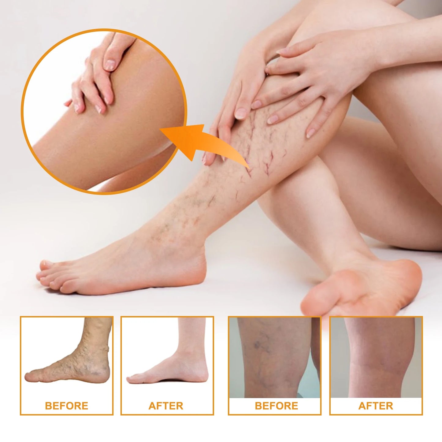 Vitamin K Cream Improve Varicose Veins.