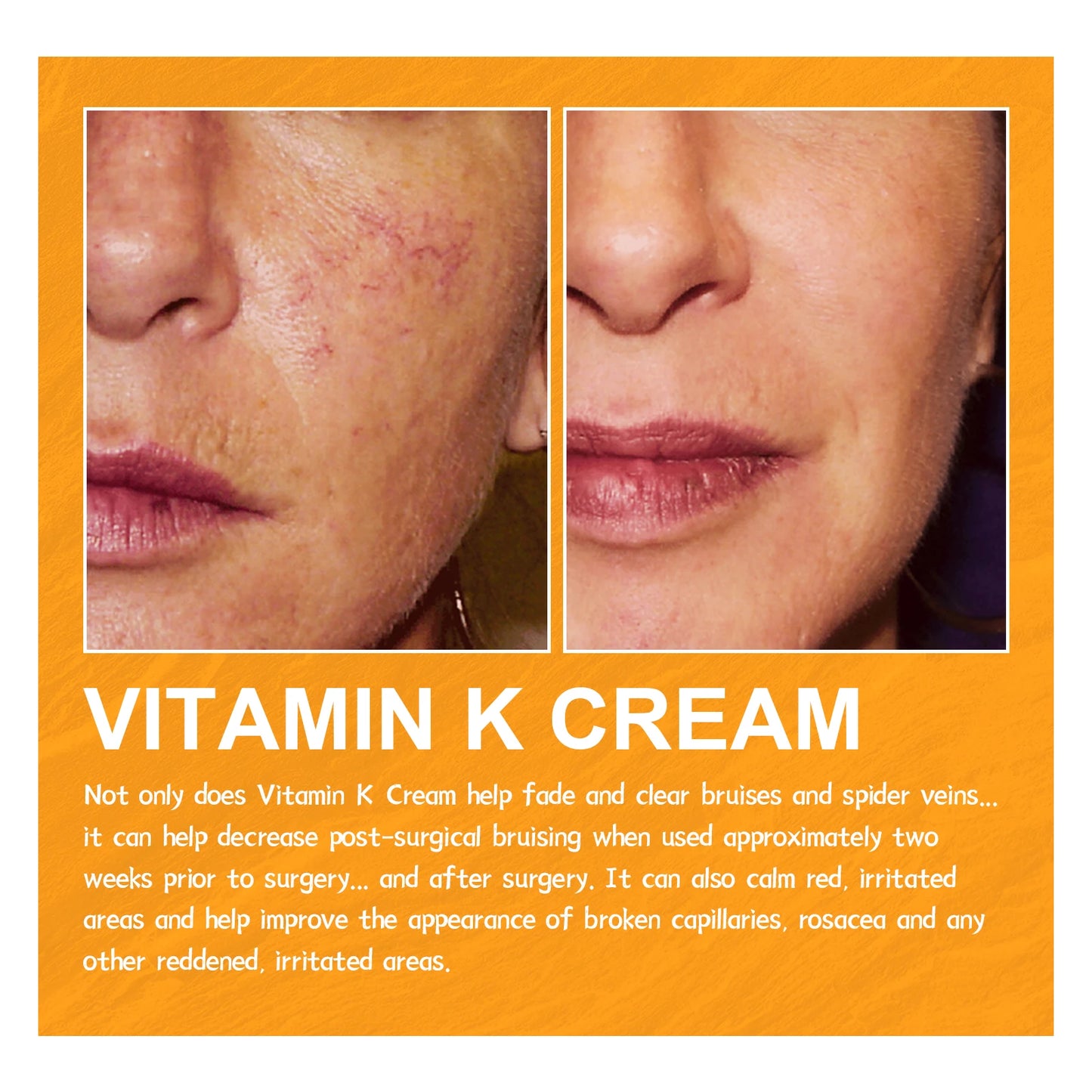Vitamin K Cream Improve Varicose Veins.
