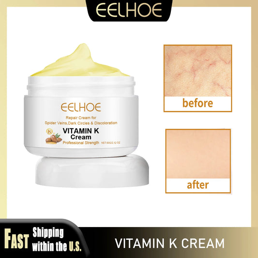 Vitamin K Cream Improve Varicose Veins.